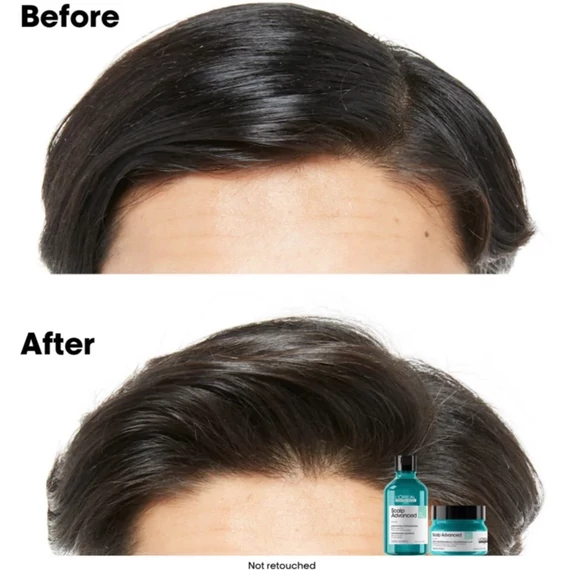 Loreal Scalp Advanced 2in1 mélytisztító sampon és pakolás zsíros hajra, 500 ml